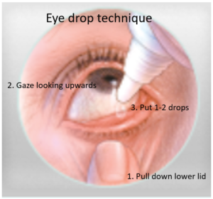 Eye drop technique