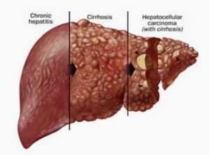 Chronic hepatitis and Cirrhosis