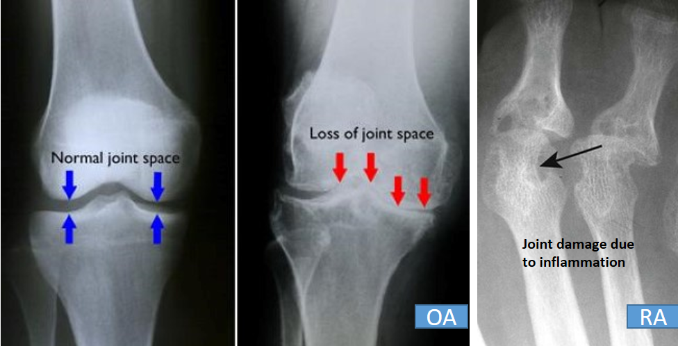 Arthritis X ray features