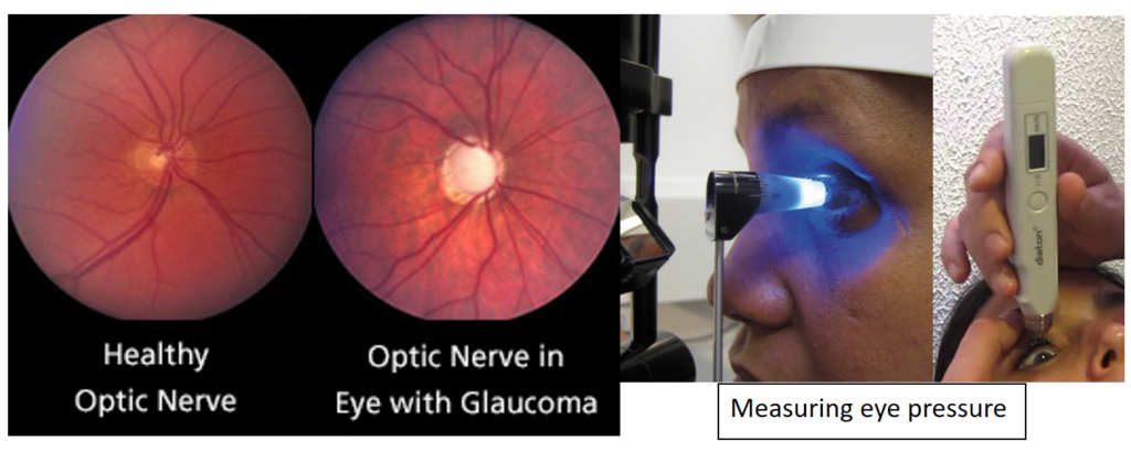 Glaucoma - What you need to know