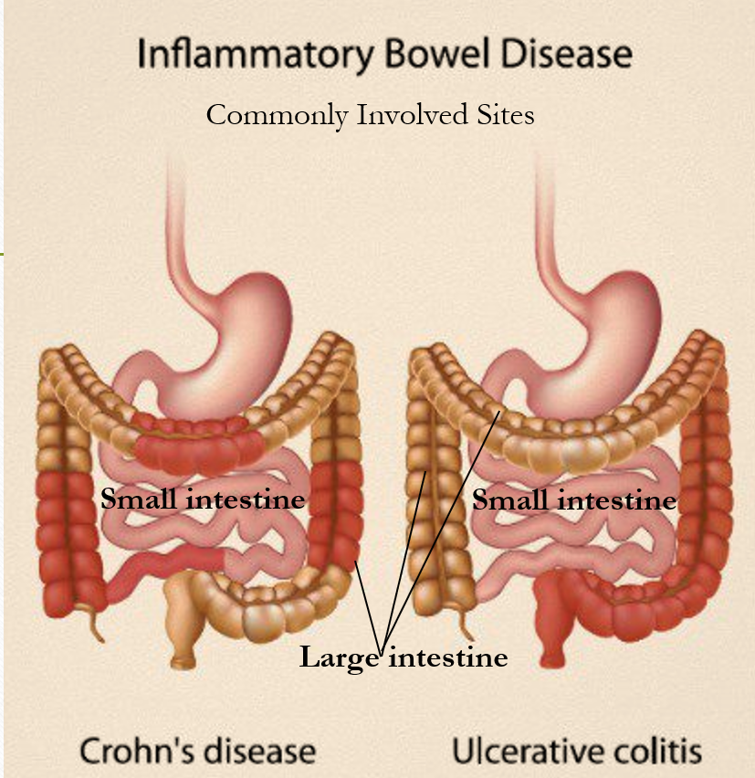 Inflammatory Bowel Disease IBD Awareness Dr Varsha pin-on-fitness