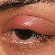 eyelid swelling