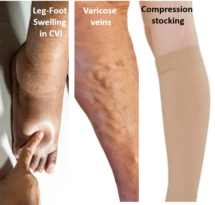 Chronic Venous Insufficiency and Varicose Veins