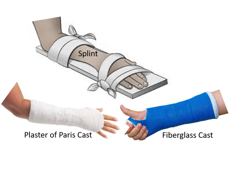 Fracture casts and splint